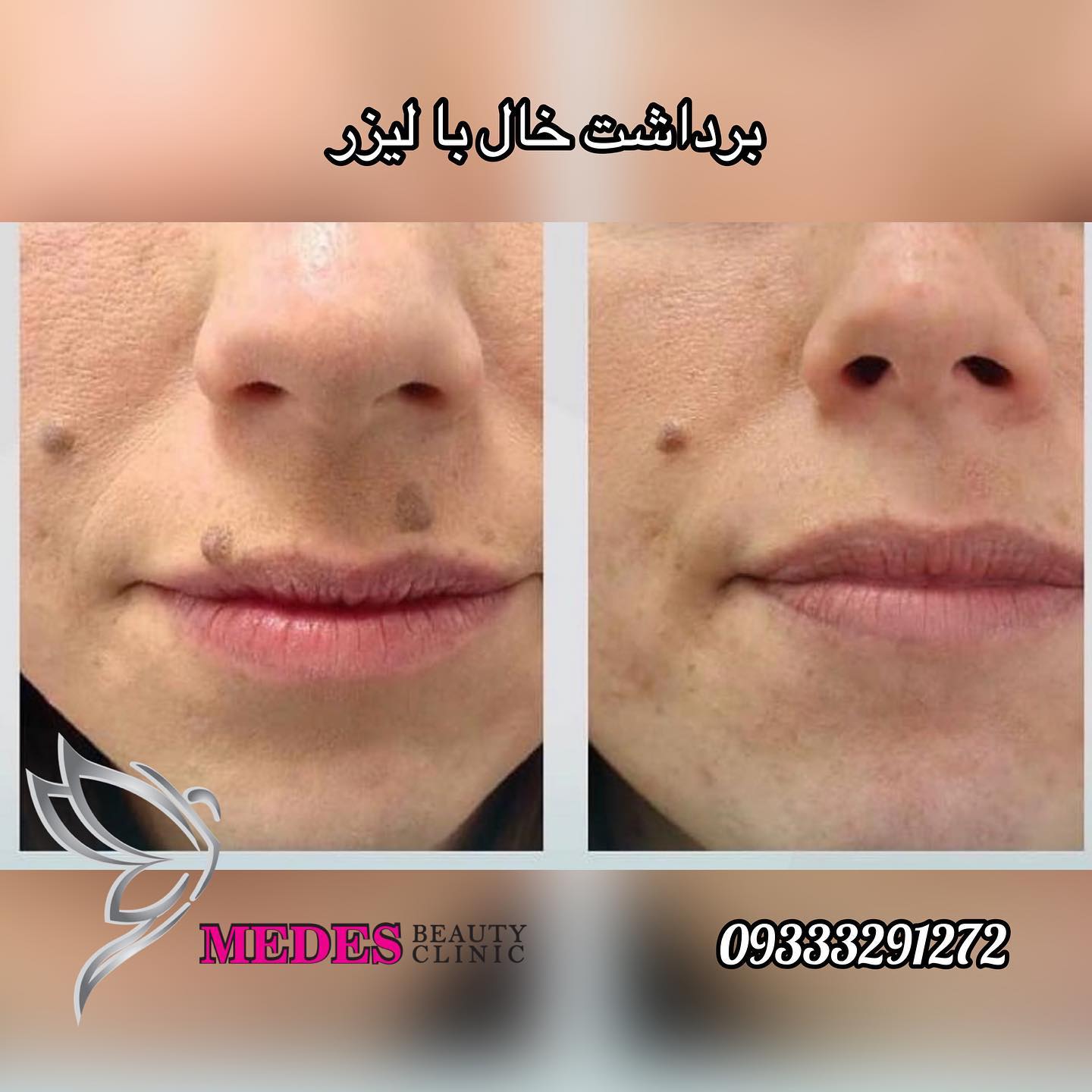 برداشت خال و زگیل